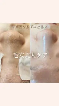 4月キャンペーン✨毛穴の黒ずみスピード毛穴洗浄🫧