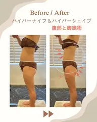 気になる箇所を選べるオーダーメイドボディ【ハイパーナイフ40分＋ハイパーシェイプ20分＋リンパマッサージ15分】