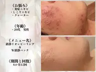【人気NO.1👑 ̖́-‬】クレーター・色素沈着ニキビ跡でお悩みの方！最強ピーリング＋W沈静パック