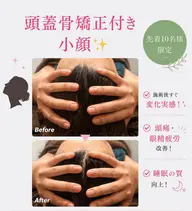 先着5名様限定【5月限定】3step小顔＋頭蓋骨矯正付き（100min）¥24,200→¥4,950