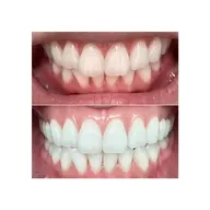 【人気】✨ホワイトニング40分+鼻毛脱毛3分✨…歯を白くして、ハミ出た鼻毛を根こそぎ無くす👃 メンズ人気