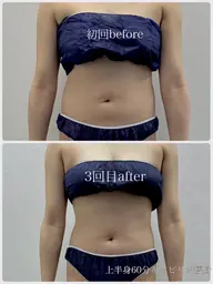 当日限定⭐️脂肪打破キャビリポ痩身60分  税込5000円