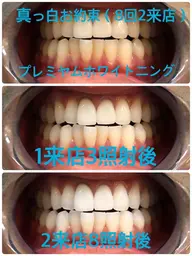 【初回限定】真っ白お約束🦷✨プレミアムホワイトニング❣️〈合計70分照射2来店コース〉❣️✨
