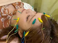 美容鍼プレミアム【電気✖︎頭皮鍼でリフトUP⤴️】