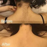 【襟足＋背中中上部脱毛】コラーゲン脱毛30分体験(シェービング付⭐︎)