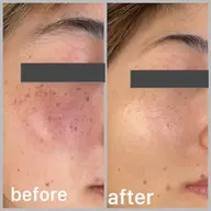 光フェイシャル回数券(3回分)   当日はノーメイクでお越し下さい