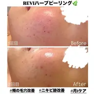 当店人気No.1メニュー✨️【 毛穴・ニキビ集中ケア 】 REVIハーブピーリング🌿