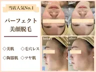 1番人気【🤍韓流美肌脱毛🤍】脱毛とフェイシャルのいいとこどり💕ピーリング＋パックでつる艶🐻‍❄️毛穴/美白/小顔