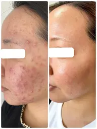 小顔＆美肌のW効果💗【超音波エステ】