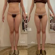 脚痩せ集中45分施術🥺🔥超高周波ラジオ波・キャビ・吸引🌸本気で変わりたい方向けクーポンの為遠方の方お断り🙇‍♀️