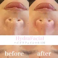 ニキビ対策＆いちご鼻撲滅Menu🍓毛穴洗浄+幹細胞パック