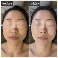 ニキビ・毛穴/本格的なのにお手軽GREEN PEEL 【2days】