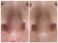 【人気Ｎｏ．1毛穴大洗浄ケア】黒ずみ除去＋小顔造形リンパエステ60分¥3000