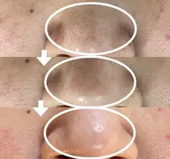 つるんと韓国肌【毛穴・黒ずみ・角栓ケア】高濃度炭酸ガス カーボキシーフェイス¥11,000→¥6,600