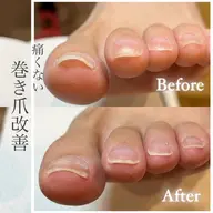 foot👣⸒⸒巻き爪改善(親指2本)