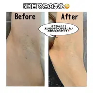 《新規》期間限定🎉特別価格🉐【ワキ脱毛¥550】施術はたったの5分⭐️ワキの匂い＆ムレや黒ずみ＆毛穴も改善♪
