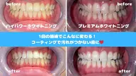 プレミアムセルフホワイトニング30分照射(15分×2)