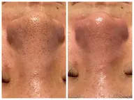 【メンズの毛穴詰まり・黒ずみ撃退‼️】ハイドラ毛穴洗浄+超保湿ケア