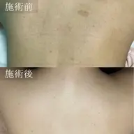 【限定クーポン⭐︎】人気No1👑全身脱毛(顔・VIO込み)¥5,000温ジェル使用