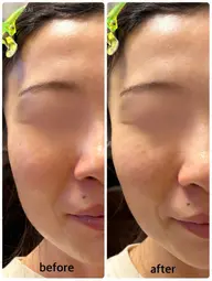 超音波エステ《エステモデル》