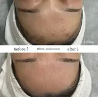 剥離なし>剥けないハーブピーリング💁🏻🫧 ※ミニモ限定価格です!