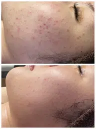 【ニキビ悩み】REVI陶肌トリートメント2g（剥けないハーブピーリング）+お任せオプション