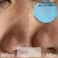 Instagramで話題！【毛穴ケアハイドラネオ】毛穴ケアのメニュー✨Tゾーン・鼻・顎のみ/EMSで輪郭スッキリ♪