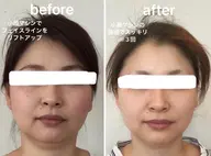 オリジナル小顔マシン⭐5000ショット⭐人気メニュー♪