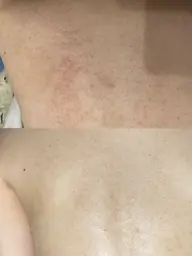 【女性限定💖】背中のハーブピーリング🌿