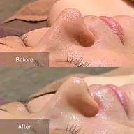 【3月限定🌸毛穴洗浄×顔脱毛】 ツルピカ卵肌へ🥚✨ 40分