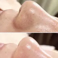 いちご鼻！毛穴ケア