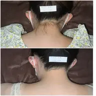 【お好きな部位を1箇所3回🌸】当店の脱毛は痛みもなくお肌が敏感な方も◎純国産機取り扱いサロン♪シェービング代無料✨