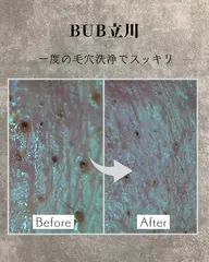 【毛穴・黒ずみ・角質を同時ケア】ハイドラ毛穴洗浄｜当サロン予約No.1！皮脂ごっそりすっきり肌へ