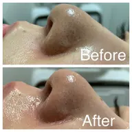 【徹底毛穴改善コース✨】ハーブピーリング×毛穴洗浄《毛穴/黒ずみ毛穴/ニキビ/肌質改善》