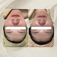 プラズマ+水玉リフティング｜たるみ・毛穴の開き お悩みの方必見👀