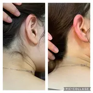 【期間限定】背中•うなじ通常8.250円⇨2.750円