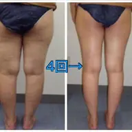 🌈痩身＋小顔矯正🌈ハイパーナイフ＋全身リンパ+筋膜リリースインド式+ドライヘッドスパ120分