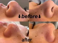 フェイシャル毛穴洗浄（ハイドラフェイシャル）