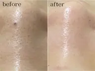 【20代人気No.1】初回限定！　鏡の近距離、もう怖くない。黒ずみ毛穴を本気でなんとかしたい人へ！