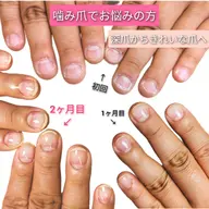 深爪＆噛み爪　★3ヶ月育成コース★