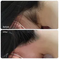 VIO+うなじ シュガーリング🍋脱毛【ご新規様】