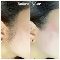 【うぶ毛＆角質ケア】フェイシャル ワックス脱毛✨