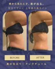 【上半身痩身】横から見た腰肉・お腹ラインが変わる痩身