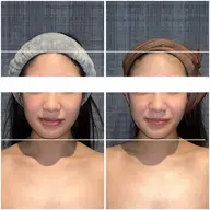 🌼モニター募集🌼ぽにょ取り✖️こりとりコルギのセットメニュー❣️最強の小顔はこれ一択です💀💛