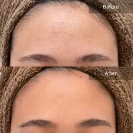 【✨1日1名様限定✨】最強小顔SET+ハーブピーリング🌿剥離あり。