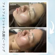 《新規ミニモ限定》春花粉のゆらぎに🌸【毛穴／透明感】乳酸ピーリング＋IPLフォトマシン（剥離なし）