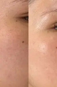 スキンケア１ヶ月モニター