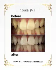 【静岡市にご勤務されている方限定】当店初回セルフホワイトニング40分8980円→0円