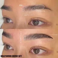 ハリウッドブロウリフト（HBL）