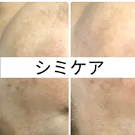 再生因子【シミシワケア】剥けないREVIハーブピーリング¥19,800→14,300(CY&NMN)